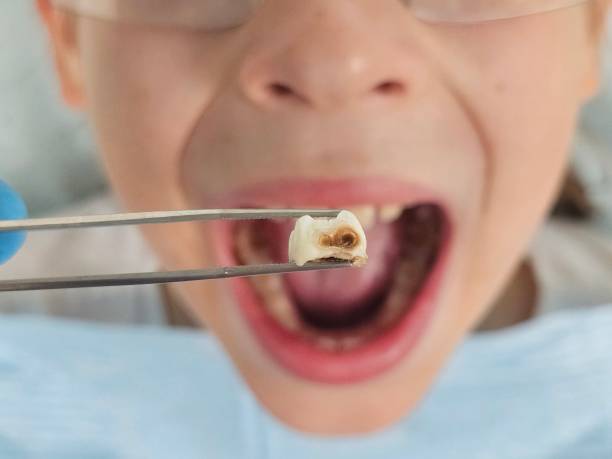 Best Emergency Root Canal Treatment in Parma, OH